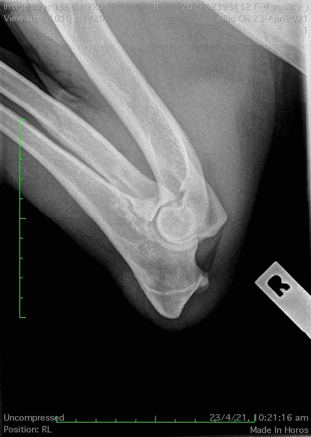 Example elbow radiograph